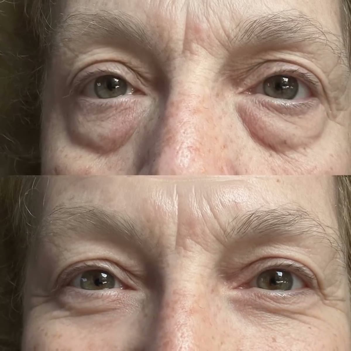 Under-eye comparison before and after Rejuva Eyes