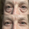 Under-eye comparison before and after Rejuva Eyes